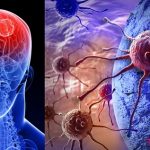 Neuromuscular Disease