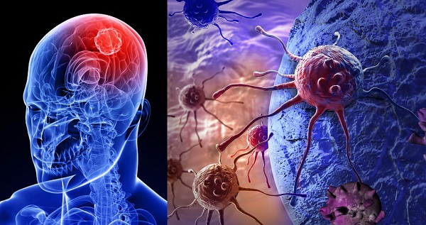 Neuromuscular Disease