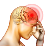Migraine